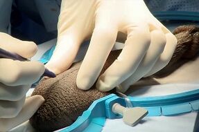 midge incision for surgical penis enlargement