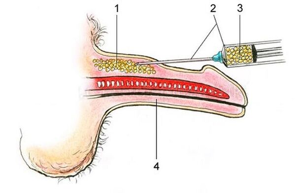 Penis enlargement with hyaluronic acid injections